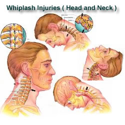 Whiplash Injury
