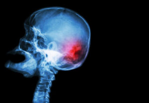 4 types of traumatic brain injuries