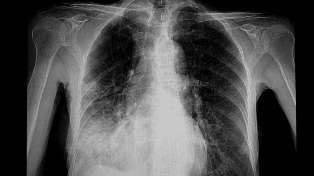 X-ray